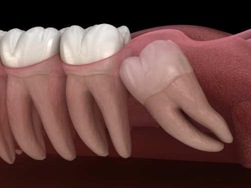 Wisdom-Teeth-in-Schaumburg-IL