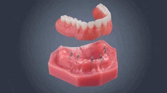 Floating Dentures in Schaumburg, IL | Mini Implant Stabilization