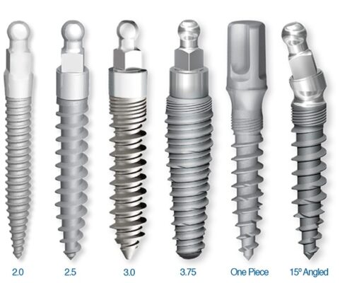 Non-Surgical Dental Implants in Schaumburg, IL | Mini Implant