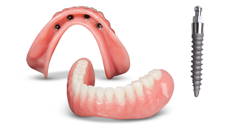 Snap-On Dentures in Schaumburg, IL | Mini Dental Implants