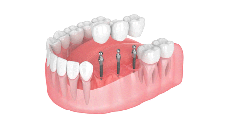 Partial Dentures in Schaumburg, IL | Implant Bridge | Mini Implants
