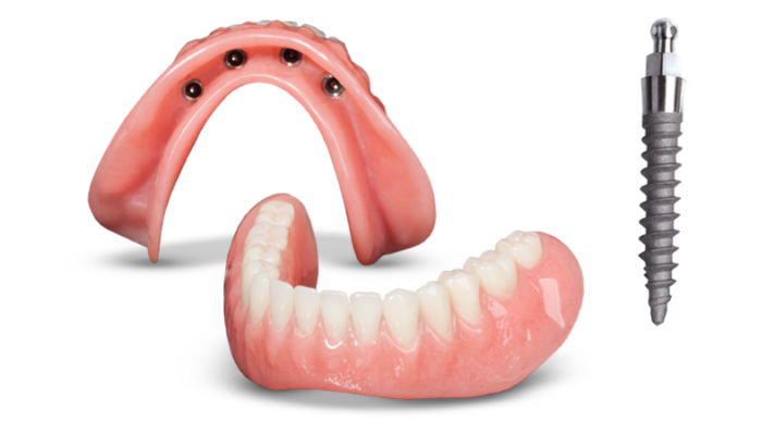 Snap-In Dentures in Schaumburg, IL | Stabilize Your Dentures