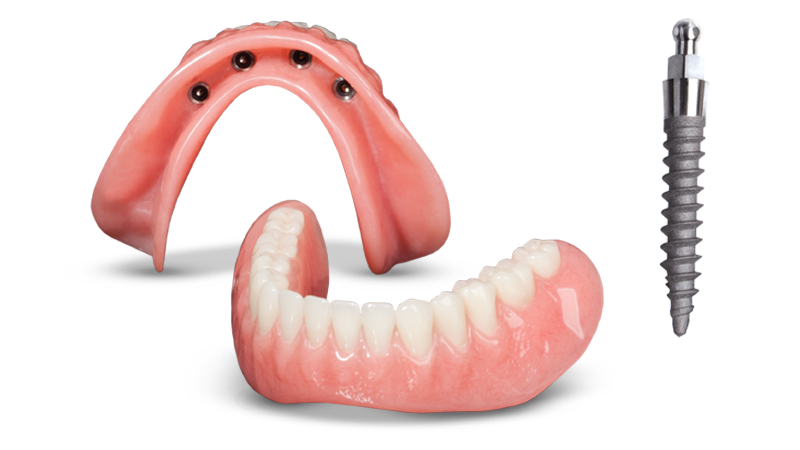 Snap-In Dentures in Schaumburg, IL | Stabilize Your Dentures