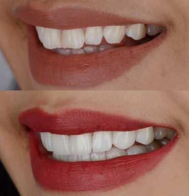 Cost of Veneers in Schaumburg, IL | Long-Lasting Smile Makeovers