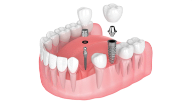 Implant Dentist in Schaumburg, IL | Free Mini Implant Consultation