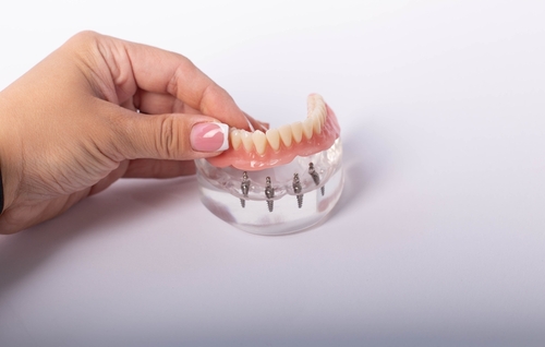 All-on-4 vs. Fix-on-Six | Denture Alternatives in Schaumburg, IL