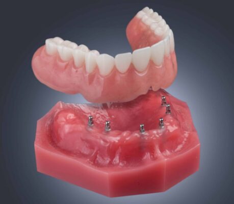 Affordable Dentures in Schaumburg, IL | Free Implant Consultations