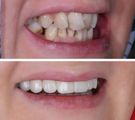 VenVeneers vs. Bonding in Schaumburg, IL | Get a Free Consultation