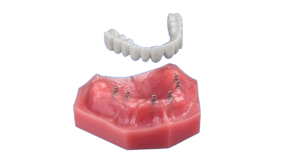 Denture Replacement in Schaumburg, IL | Free Implant Consult!