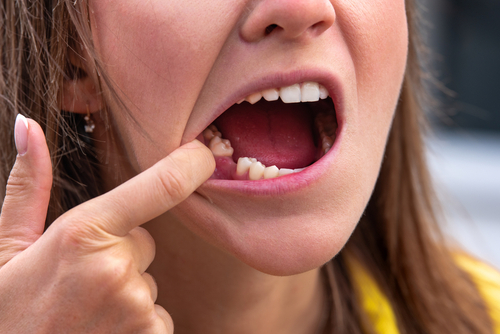 Emergency Dental Extraction in Schaumburg, IL | Protecting Smiles