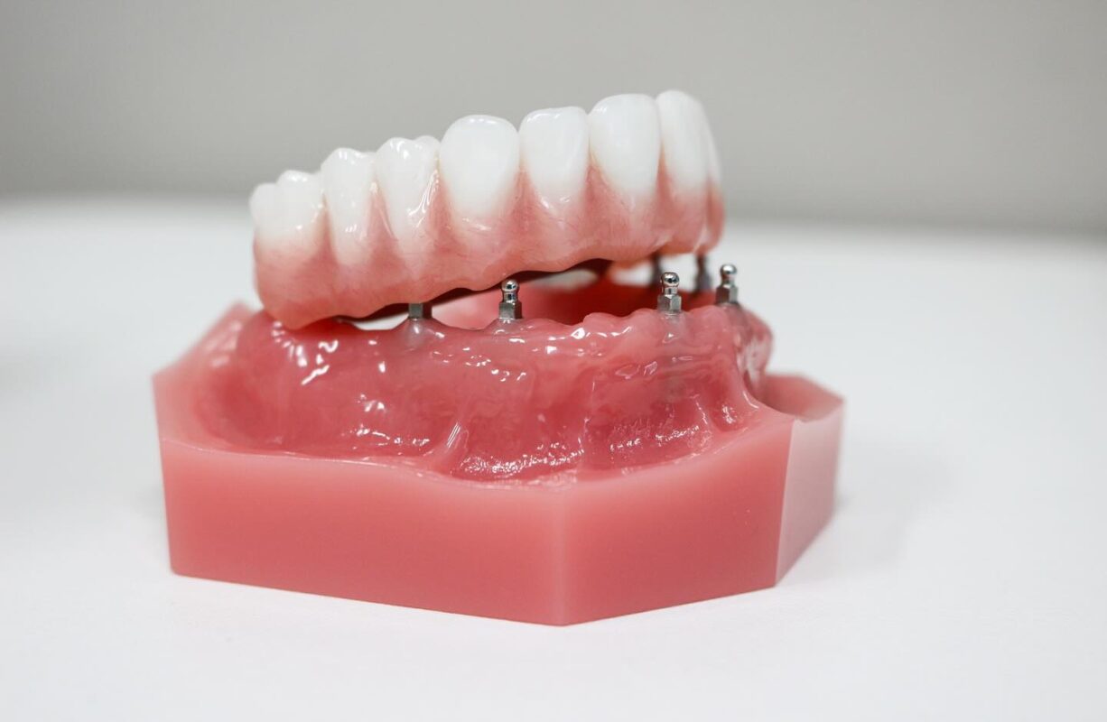 Lower Denture Implants in Schaumburg, IL | Free Consultations