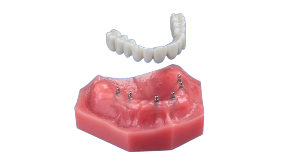 Implants for Denture Security in Schaumburg, IL | Free Consultation